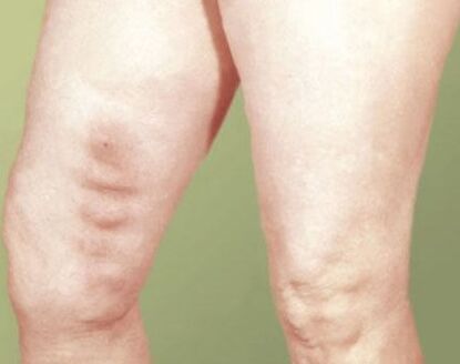 Flebitis