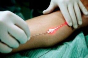 Lasersko liječenje varikoznih vena na nogama