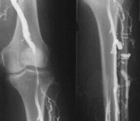 Mogućnosti dijagnoze proširenih vena ekstremiteta