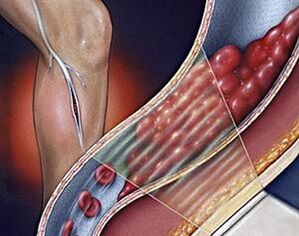 proširene vene dubokih vena donjih ekstremiteta